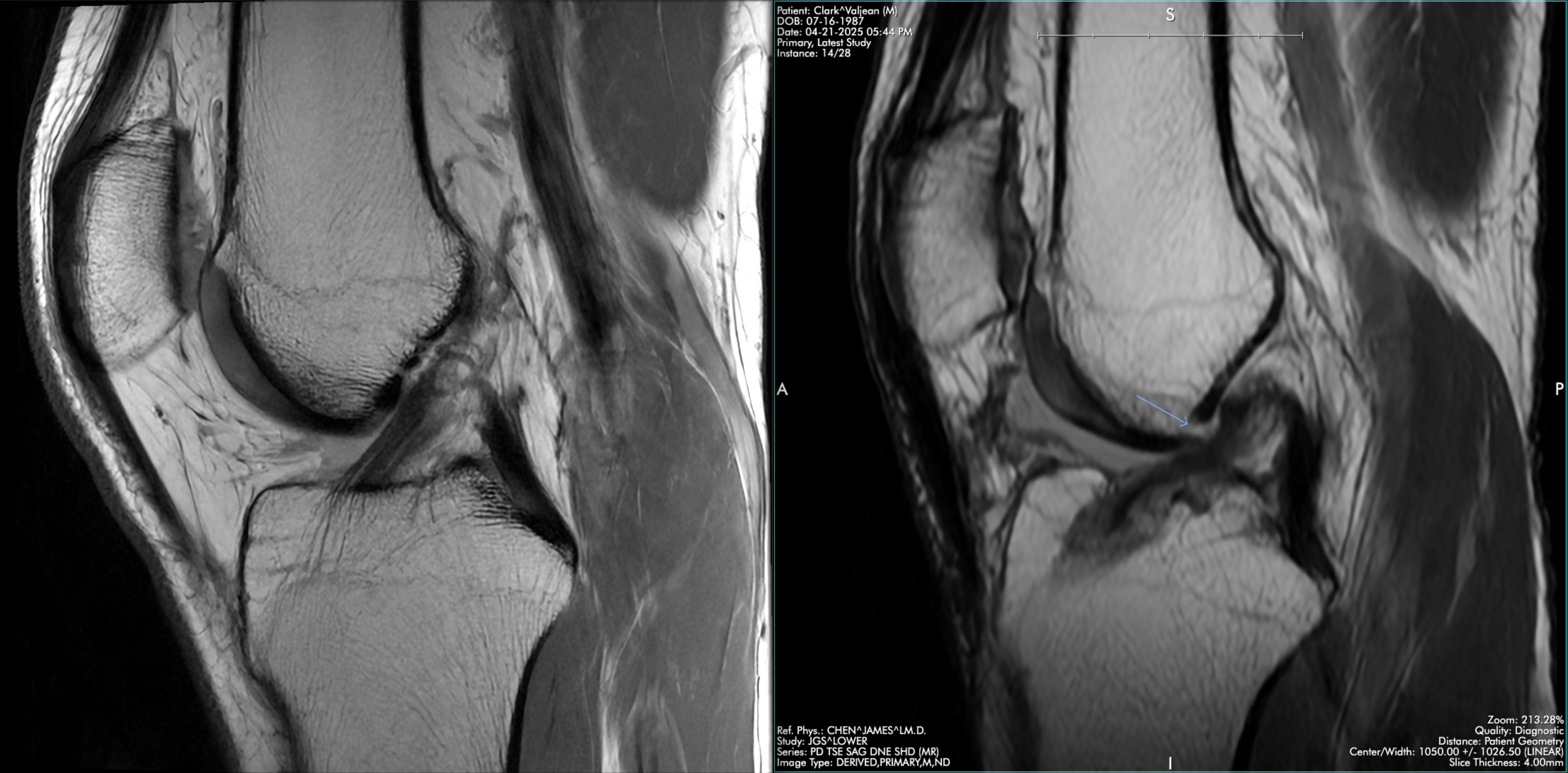 Left/right ACL comparison